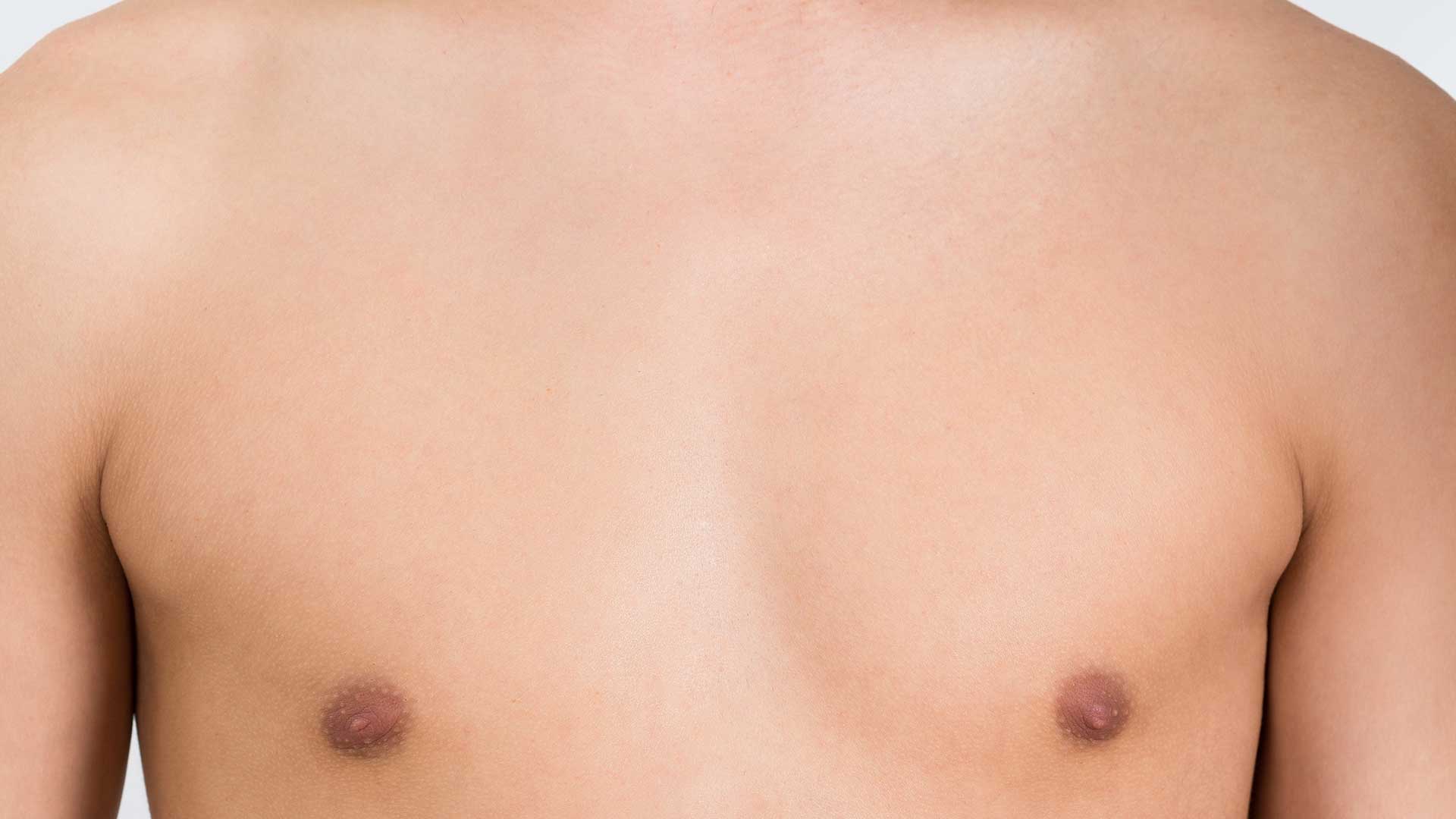 Gynecomastie